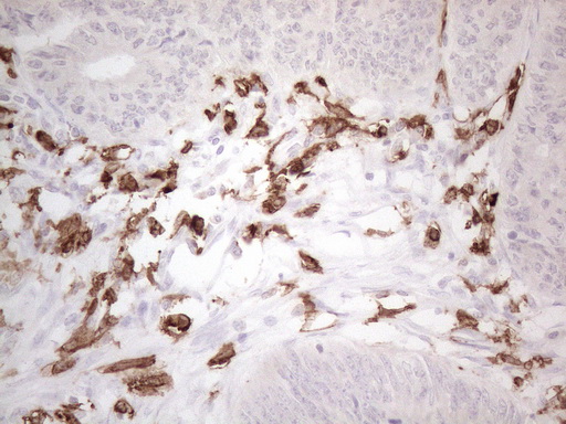 ITGAM / CD11b Antibody - Immunohistochemical staining of paraffin-embedded Adenocarcinoma of Human colon tissue using anti-ITGAM mouse monoclonal antibody. (Heat-induced epitope retrieval by 1mM EDTA in 10mM Tris buffer. (pH8.5) at 120°C for 3 min. (1:150)