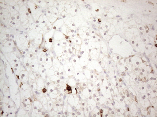 ITGAM / CD11b Antibody - Immunohistochemical staining of paraffin-embedded Carcinoma of Human kidney tissue using anti-ITGAM mouse monoclonal antibody. (Heat-induced epitope retrieval by 1mM EDTA in 10mM Tris buffer. (pH8.5) at 120°C for 3 min. (1:150)