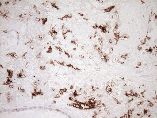 ITGAM / CD11b Antibody - Immunohistochemical staining of paraffin-embedded Carcinoma of Human lung tissue using anti-ITGAM mouse monoclonal antibody. (Heat-induced epitope retrieval by 1mM EDTA in 10mM Tris buffer. (pH8.5) at 120°C for 3 min. (1:150)
