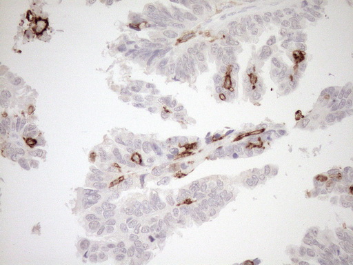 ITGAM / CD11b Antibody - Immunohistochemical staining of paraffin-embedded Adenocarcinoma of Human ovary tissue using anti-ITGAM mouse monoclonal antibody. (Heat-induced epitope retrieval by 1mM EDTA in 10mM Tris buffer. (pH8.5) at 120°C for 3 min. (1:150)