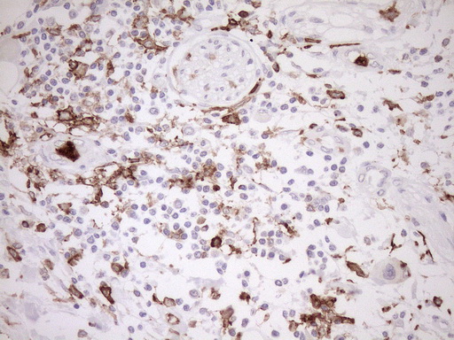 ITGAM / CD11b Antibody - Immunohistochemical staining of paraffin-embedded Carcinoma of Human pancreas tissue using anti-ITGAM mouse monoclonal antibody. (Heat-induced epitope retrieval by 1mM EDTA in 10mM Tris buffer. (pH8.5) at 120°C for 3 min. (1:150)