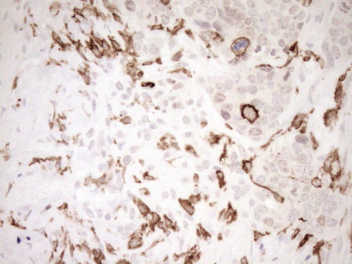 ITGAM / CD11b Antibody - Immunohistochemical staining of paraffin-embedded Adenocarcinoma of Human endometrium tissue using anti-ITGAM mouse monoclonal antibody. (Heat-induced epitope retrieval by 1mM EDTA in 10mM Tris buffer. (pH8.5) at 120°C for 3 min. (1:150)