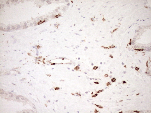 ITGAM / CD11b Antibody - Immunohistochemical staining of paraffin-embedded Carcinoma of Human prostate tissue using anti-ITGAM mouse monoclonal antibody. (Heat-induced epitope retrieval by 1mM EDTA in 10mM Tris buffer. (pH8.5) at 120°C for 3 min. (1:150)