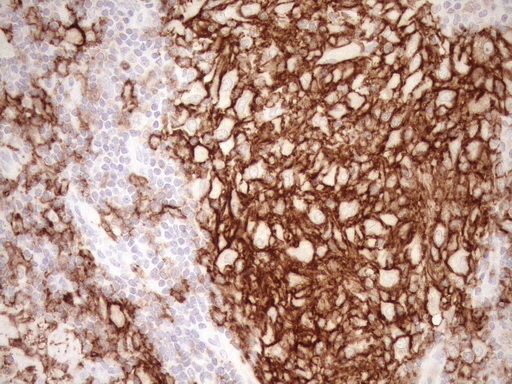 ITGAM / CD11b Antibody - Immunohistochemical staining of paraffin-embedded Human lymph node tissue within the normal limits using anti-ITGAM mouse monoclonal antibody. (Heat-induced epitope retrieval by 1mM EDTA in 10mM Tris buffer. (pH8.5) at 120°C for 3 min. (1:150)