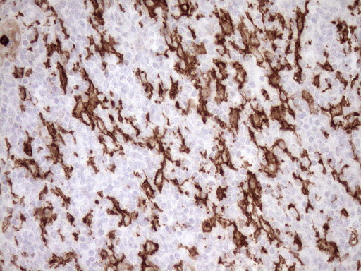 ITGAM / CD11b Antibody - Immunohistochemical staining of paraffin-embedded Human lymphoma tissue using anti-ITGAM mouse monoclonal antibody. (Heat-induced epitope retrieval by 1mM EDTA in 10mM Tris buffer. (pH8.5) at 120°C for 3 min. (1:150)