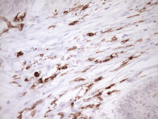 ITGAM / CD11b Antibody - Immunohistochemical staining of paraffin-embedded Adenocarcinoma of Human colon tissue using anti-ITGAM mouse monoclonal antibody. (Heat-induced epitope retrieval by 1mM EDTA in 10mM Tris buffer. (pH8.5) at 120°C for 3 min. (1:150)