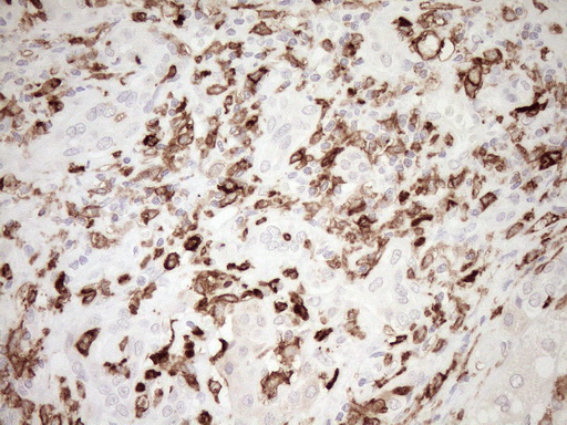 ITGAM / CD11b Antibody - Immunohistochemical staining of paraffin-embedded Carcinoma of Human liver tissue using anti-ITGAM mouse monoclonal antibody. (Heat-induced epitope retrieval by 1mM EDTA in 10mM Tris buffer. (pH8.5) at 120°C for 3 min. (1:150)