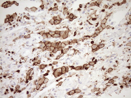 ITGAM / CD11b Antibody - Immunohistochemical staining of paraffin-embedded Human lung tissue within the normal limits using anti-ITGAM mouse monoclonal antibody. (Heat-induced epitope retrieval by 1mM EDTA in 10mM Tris buffer. (pH8.5) at 120°C for 3 min. (1:150)