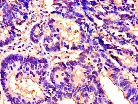 ITGAM / CD11b Antibody - Immunohistochemistry of paraffin-embedded human colon cancer using ITGAM Antibody at dilution of 1:100