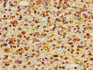 ITGAV/Integrin Alpha V/CD51 Antibody - Immunohistochemistry image of paraffin-embedded human glioma cancer at a dilution of 1:100