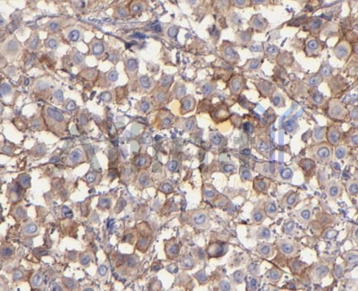 ITGAV/Integrin Alpha V/CD51 Antibody - 1/100 staining human lung tissue by IHC-P. The sample was formaldehyde fixed and a heat mediated antigen retrieval step in citrate buffer was performed. The sample was then blocked and incubated with the antibody for 1.5 hours at 22°C. An HRP conjugated goat anti-rabbit antibody was used as the secondary antibody.