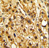 ITGAX / CD11c Antibody - Formalin-fixed and paraffin-embedded human hepatocarcinoma with ITGAX Antibody , which was peroxidase-conjugated to the secondary antibody, followed by DAB staining. This data demonstrates the use of this antibody for immunohistochemistry; clinical relevance has not been evaluated.