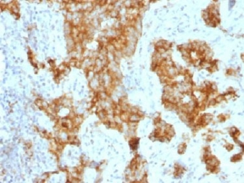 ITGAX / CD11c Antibody - IHC testing of FFPE human prostate carcinoma with CD11c antibody (clone ITGAX/1243). Note staining of cancer cells. Required HIER: boil tissue sections in 10mM Tris with 1mM EDTA, pH 9.0, for 10-20 min.