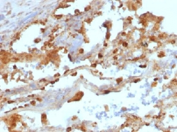 ITGAX / CD11c Antibody - IHC testing of FFPE human lung carcinoma with CD11c antibody (clone ITGAX/1243). Note staining of cancer cells. Required HIER: boil tissue sections in 10mM Tris with 1mM EDTA, pH 9.0, for 10-20 min.