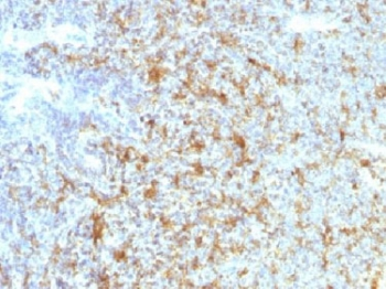 ITGAX / CD11c Antibody - IHC testing of FFPE human follicular lymphoma with CD11c antibody (clone ITGAX/1243). Note staining of cancer cells. Required HIER: boil tissue sections in 10mM Tris with 1mM EDTA, pH 9.0, for 10-20 min.