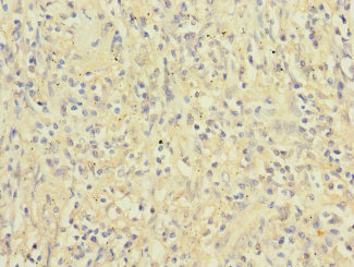 ITGAX / CD11c Antibody - Immunohistochemistry of paraffin-embedded human lung cancer at dilution 1:100