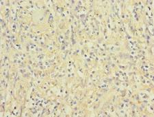 ITGAX / CD11c Antibody - Immunohistochemistry of paraffin-embedded human lung cancer at dilution 1:100