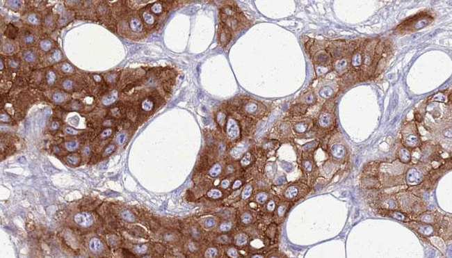 ITGAX / CD11c Antibody - 1:100 staining human Head and neck carcinoma tissue by IHC-P. The sample was formaldehyde fixed and a heat mediated antigen retrieval step in citrate buffer was performed. The sample was then blocked and incubated with the antibody for 1.5 hours at 22°C. An HRP conjugated goat anti-rabbit antibody was used as the secondary.