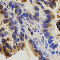 ITGB1 / Integrin Beta 1 / CD29 Antibody - Immunohistochemical analysis of CD29 staining in human lung cancer formalin fixed paraffin embedded tissue section. The section was pre-treated using heat mediated antigen retrieval with sodium citrate buffer (pH 6.0). The section was then incubated with the antibody at room temperature and detected using an HRP polymer system. DAB was used as the chromogen. The section was then counterstained with hematoxylin and mounted with DPX.