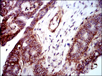 ITGB1 / Integrin Beta 1 / CD29 Antibody - IHC of paraffin-embedded ovarian cancer tissues using ITGB1 mouse monoclonal antibody with DAB staining.