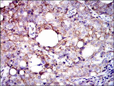 ITGB1 / Integrin Beta 1 / CD29 Antibody - IHC of paraffin-embedded cervical cancer tissues using ITGB1 mouse monoclonal antibody with DAB staining.