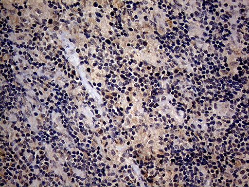 ITGB1 / Integrin Beta 1 / CD29 Antibody - Immunohistochemical staining of paraffin-embedded Carcinoma of Human lung tissue using anti-ITGB1 mouse monoclonal antibody. (Heat-induced epitope retrieval by 1mM EDTA in 10mM Tris buffer. (pH8.5) at 120°C for 3 min. (1:150)