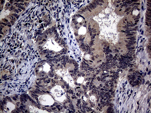 ITGB1 / Integrin Beta 1 / CD29 Antibody - Immunohistochemical staining of paraffin-embedded Adenocarcinoma of Human colon tissue using anti-ITGB1 mouse monoclonal antibody. (Heat-induced epitope retrieval by 1mM EDTA in 10mM Tris buffer. (pH8.5) at 120°C for 3 min. (1:150)