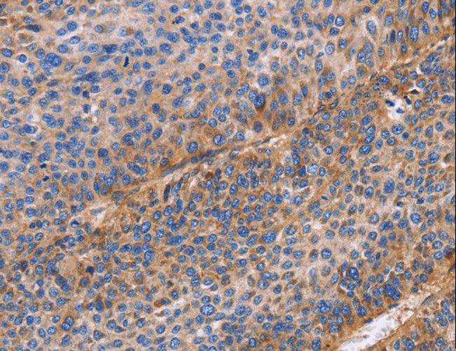 ITGB1 / Integrin Beta 1 / CD29 Antibody - Immunohistochemistry of paraffin-embedded Human liver cancer using ITGB1 Polyclonal Antibody at dilution of 1:60.