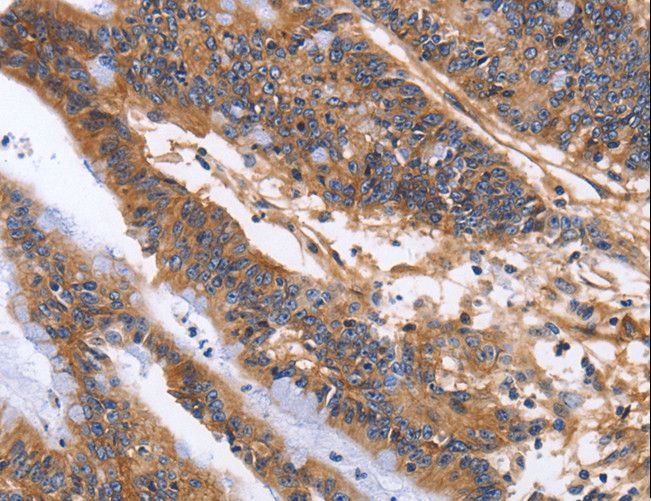 ITGB1 / Integrin Beta 1 / CD29 Antibody - Immunohistochemistry of paraffin-embedded Human colon cancer using ITGB1 Polyclonal Antibody at dilution of 1:60.