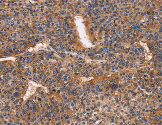 ITGB1 / Integrin Beta 1 / CD29 Antibody - Immunohistochemistry of paraffin-embedded Human liver cancer using ITGB1 Polyclonal Antibody at dilution of 1:50.