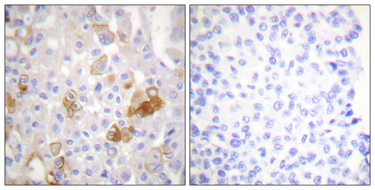 ITGB1 / Integrin Beta 1 / CD29 Antibody - Immunohistochemistry analysis of paraffin-embedded human breast carcinoma, using Integrin beta1 (Phospho-Thr788) Antibody. The picture on the right is blocked with the phospho peptide.