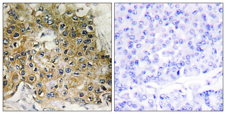 ITGB1 / Integrin Beta 1 / CD29 Antibody - Immunohistochemistry analysis of paraffin-embedded human breast carcinoma, using Integrin beta1 (Phospho-Thr789) Antibody. The picture on the right is blocked with the phospho peptide.
