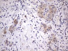 ITGB1BP1 / ICAP1 Antibody - IHC of paraffin-embedded Carcinoma of Human pancreas tissue using anti-ITGB1BP1 mouse monoclonal antibody. (Heat-induced epitope retrieval by 1 mM EDTA in 10mM Tris, pH8.5, 120°C for 3min).