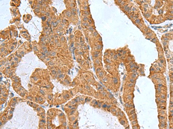 ITGB1BP1 / ICAP1 Antibody - Immunohistochemistry of paraffin-embedded Human thyroid cancer tissue  using ITGB1BP1 Polyclonal Antibody at dilution of 1:50(×200)