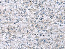 ITGB1BP1 / ICAP1 Antibody - Immunohistochemistry of paraffin-embedded Human liver cancer tissue  using ITGB1BP1 Polyclonal Antibody at dilution of 1:60(×200)