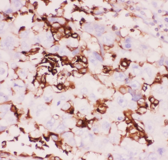 ITGB2 / CD18 Antibody - CD18 antibody IHC-paraffin: Human Lung Cancer Tissue.