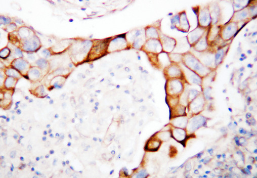 ITGB2 / CD18 Antibody - ITGB2 / MAC-1 / CD18 antibody. IHC(P): Human Breast Cancer Tissue.