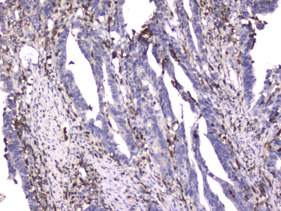 ITGB2 / CD18 Antibody - IHC analysis of CD18 using anti-CD18 antibody. CD18 was detected in paraffin-embedded section of human rectal cancer tissue. Heat mediated antigen retrieval was performed in citrate buffer (pH6, epitope retrieval solution) for 20 mins. The tissue section was blocked with 10% goat serum. The tissue section was then incubated with 2µg/ml mouse anti-CD18 antibody overnight at 4°C. Biotinylated goat anti-mouse IgG was used as secondary antibody and incubated for 30 minutes at 37°C. The tissue section was developed using Strepavidin-Biotin-Complex (SABC) with DAB as the chromogen.