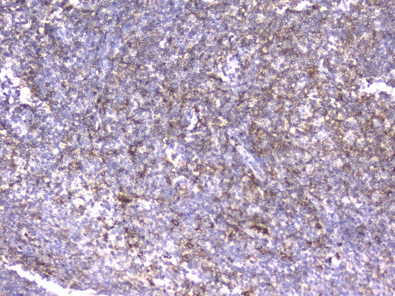 ITGB2 / CD18 Antibody - IHC analysis of CD18 using anti-CD18 antibody. CD18 was detected in paraffin-embedded section of human tonsil tissue. Heat mediated antigen retrieval was performed in citrate buffer (pH6, epitope retrieval solution) for 20 mins. The tissue section was blocked with 10% goat serum. The tissue section was then incubated with 2µg/ml rabbit anti-CD18 antibody overnight at 4°C. Biotinylated goat anti-mouse IgG was used as secondary antibody and incubated for 30 minutes at 37°C. The tissue section was developed using Strepavidin-Biotin-Complex (SABC) with DAB as the chromogen.