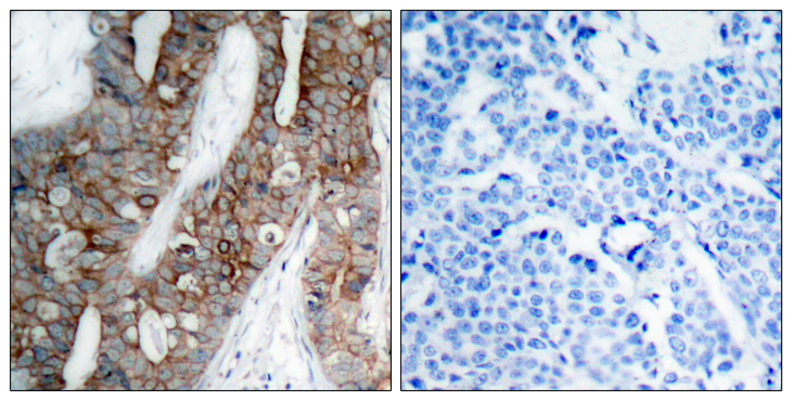 ITGB3 / Integrin Beta 3 / CD61 Antibody - Immunohistochemistry analysis of paraffin-embedded human breast carcinoma tissue, using Integrin beta3 Antibody. The picture on the right is blocked with the synthesized peptide.