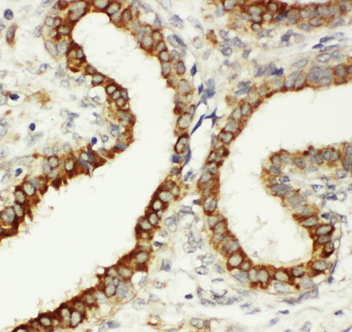 ITGB3 / Integrin Beta 3 / CD61 Antibody - ITGB3 / Integrin Beta 3 / CD61 antibody. IHC(P): Human Breast Cancer Tissue.