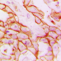 ITGB3 / Integrin Beta 3 / CD61 Antibody - Immunohistochemical analysis of CD61 staining in human breast cancer formalin fixed paraffin embedded tissue section. The section was pre-treated using heat mediated antigen retrieval with sodium citrate buffer (pH 6.0). The section was then incubated with the antibody at room temperature and detected using an HRP conjugated compact polymer system. DAB was used as the chromogen. The section was then counterstained with hematoxylin and mounted with DPX.