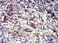 ITGB3 / Integrin Beta 3 / CD61 Antibody - Immunohistochemical analysis of paraffin-embedded bladder cancer tissues using CD61 mouse mAb with DAB staining.