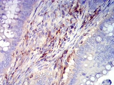 ITGB3 / Integrin Beta 3 / CD61 Antibody - Immunohistochemical analysis of paraffin-embedded rectum cancer tissues using CD61 mouse mAb with DAB staining.