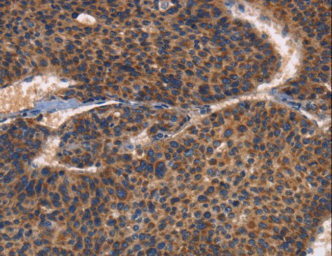 ITGB3 / Integrin Beta 3 / CD61 Antibody - Immunohistochemistry of paraffin-embedded Human liver cancer using ITGB3 Polyclonal Antibody at dilution of 1:30.
