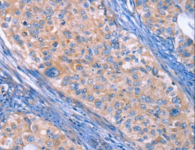 ITGB3 / Integrin Beta 3 / CD61 Antibody - Immunohistochemistry of paraffin-embedded Human cervical cancer using ITGB3 Polyclonal Antibody at dilution of 1:30.