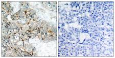 ITGB3 / Integrin Beta 3 / CD61 Antibody - Immunohistochemistry analysis of paraffin-embedded human breast carcinoma, using Integrin beta3 (Phospho-Tyr773) Antibody. The picture on the right is blocked with the phospho peptide.