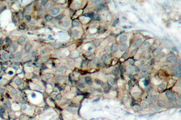 ITGB3 / Integrin Beta 3 / CD61 Antibody - IHC of p-Integrin 3 (Y773) pAb in paraffin-embedded human breast carcinoma tissue.