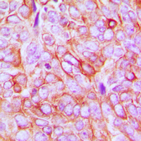 ITGB3 / Integrin Beta 3 / CD61 Antibody - Immunohistochemical analysis of CD61 (pY773) staining in human breast cancer formalin fixed paraffin embedded tissue section. The section was pre-treated using heat mediated antigen retrieval with sodium citrate buffer (pH 6.0). The section was then incubated with the antibody at room temperature and detected using an HRP conjugated compact polymer system. DAB was used as the chromogen. The section was then counterstained with hematoxylin and mounted with DPX.