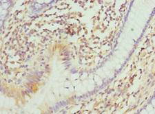 ITGB3BP Antibody - Immunohistochemistry of paraffin-embedded human colon cancer at dilution 1:100